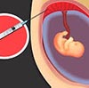 Terapia Fetal- Procedimientos invasivos
