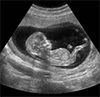 Ultrasonografía Perinatal